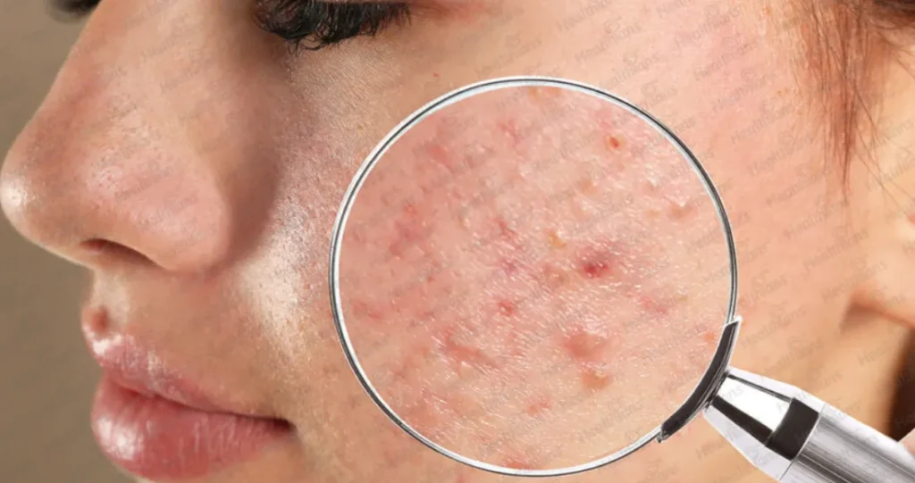 Advanced Care for Acne, Eczema, and More