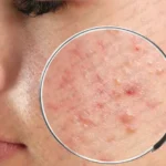 Advanced Care for Acne, Eczema, and More
