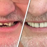 Advanced Dental Implants for a Strong, Natural and Comfortable Result