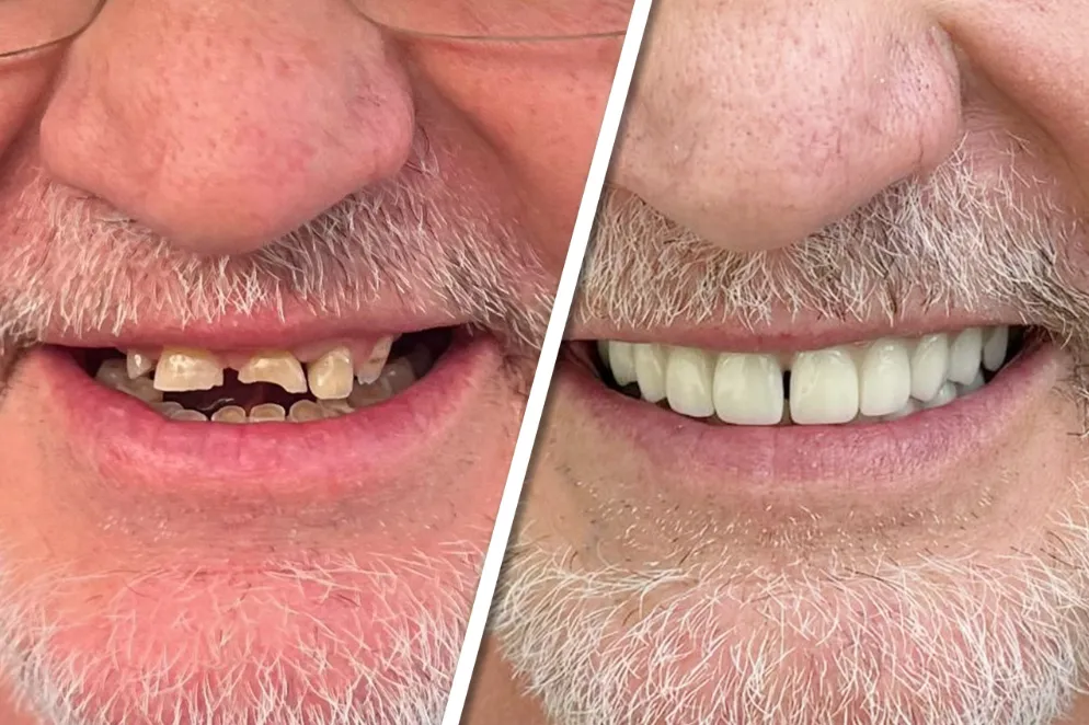 Advanced Dental Implants for a Strong, Natural and Comfortable Result