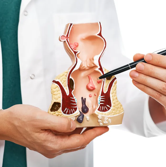 Grade 3 and 4 Piles Explained When You May Need Haemorrhoids Surgery Singapore Treatment