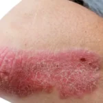Skin Clinic Singapore for Psoriasis Modern Medical Treatment Options