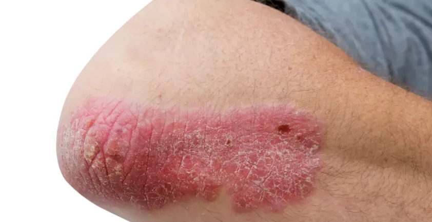 Skin Clinic Singapore for Psoriasis Modern Medical Treatment Options